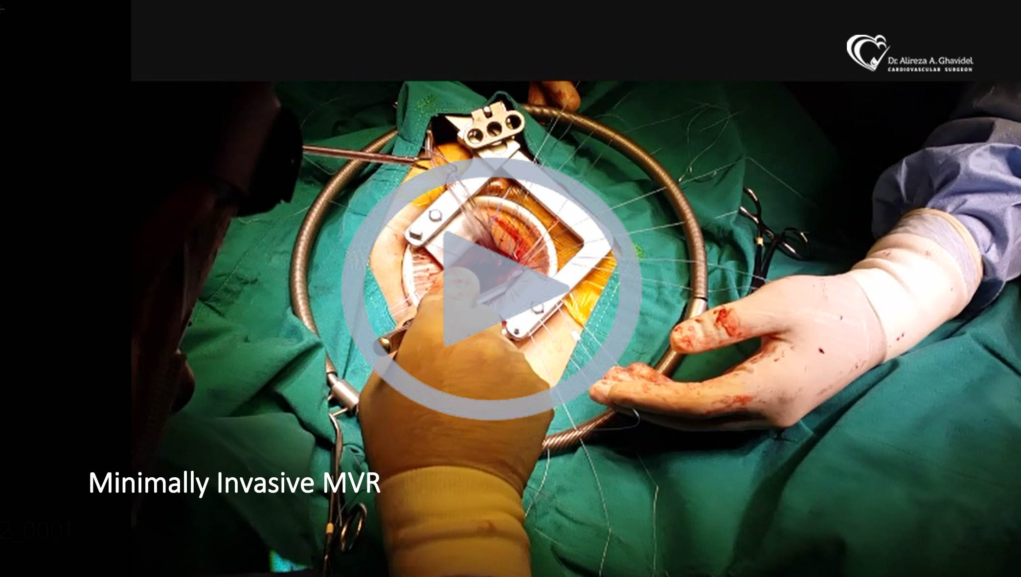 Minimally Invasive MVR