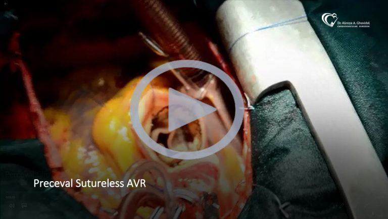 Perceval Sutureless AVR