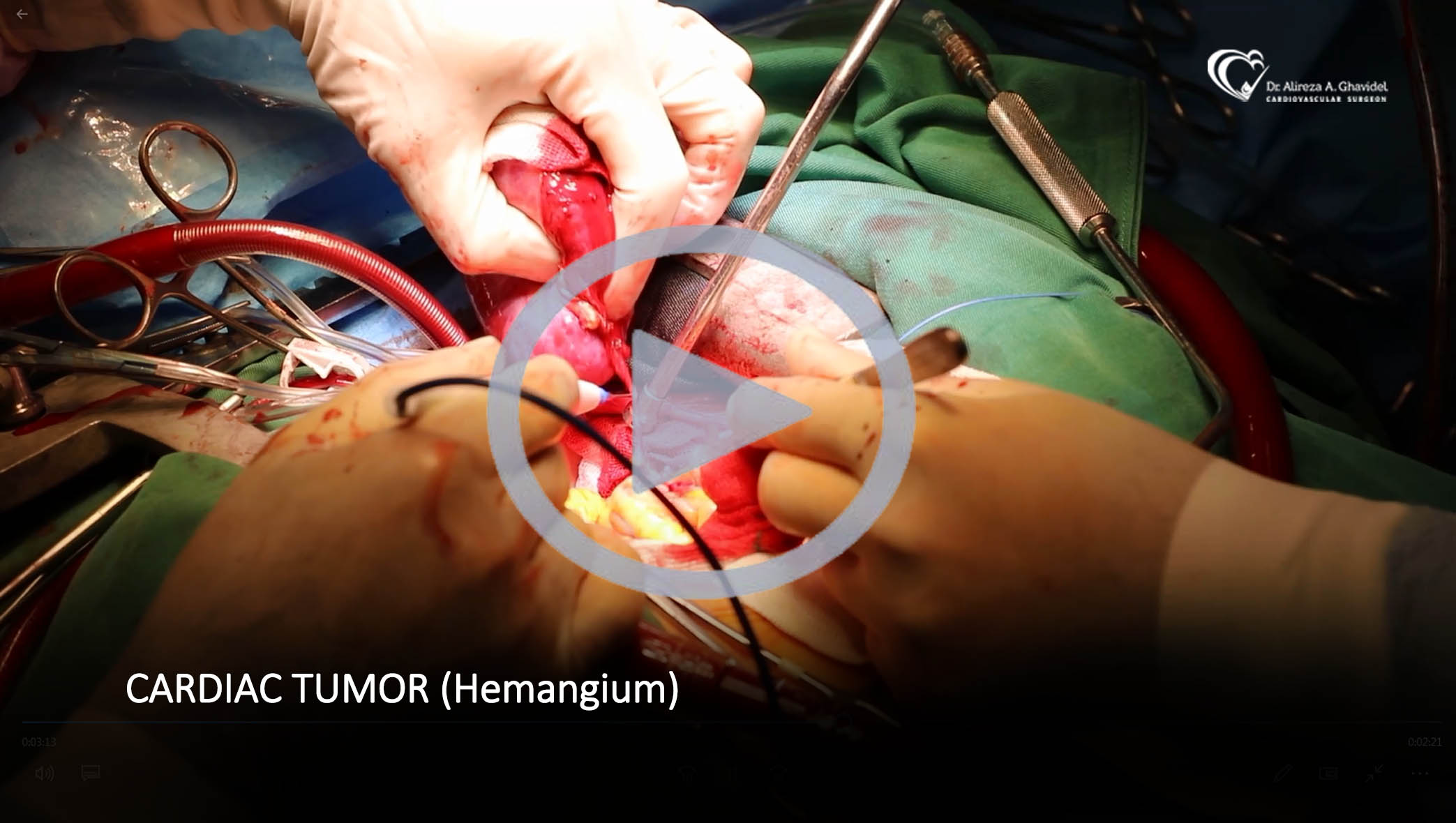 Cardiac Tumor (Hemangium)