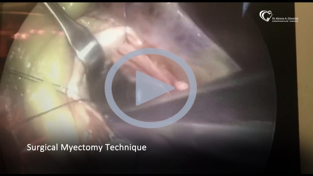 Surgical Myectomy Technique
