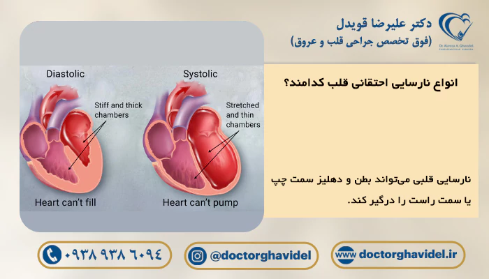 انواع نارسایی احتقانی قلب کدامند؟