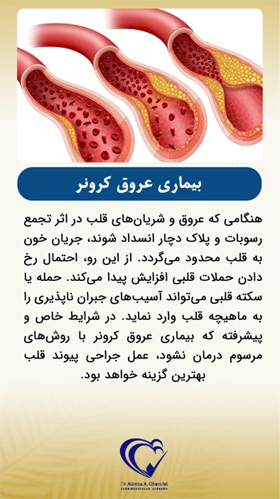 رسوبات داخل عروق کرونر 