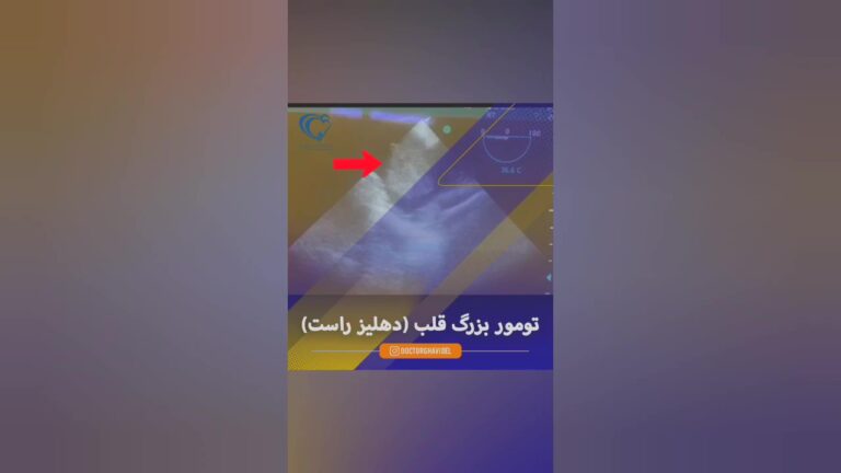 جراحی تومور بزرگ قلب