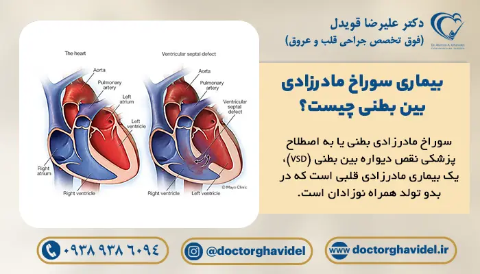 تصویر نشان دهنده سوراخ مادرزادی بین بطنی (بیماری VSD)