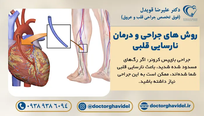 استفاده از رگ پا برای بای پس عروق کرونری برای جلوگیری از مرگ بر اثر نارسایی قلبی