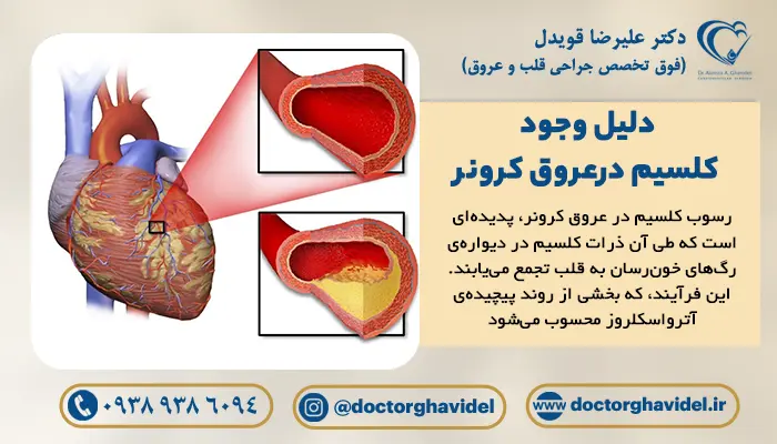 روند طبیعی افزایش سن، اختلالات متابولیک و آسیب عروق از دلایل وجود کلسیم در عروق کرونر هستند.