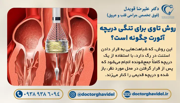 ورود کاتتر به داخل قلب در عمل تاوی قلب