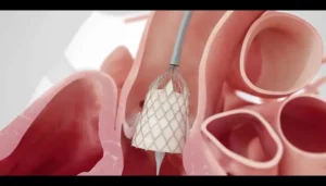 تصویر گرافیکی کاتتر در داخل دریچه قلب در مقاله تفاوت روش جراحی کم تهاجمی آئورت با تاوی