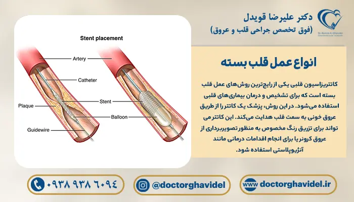 تصویر استنت در داخل رگ در عمل قلب بسته