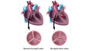 تصویر کارتونی دریچه آئورت سه لتی و دریچه آئورت دو لتی